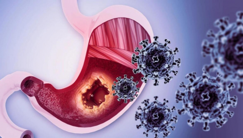 重视早筛工作，癌症可防可控，觅瑞GASTROClear™为人类健康增加保障