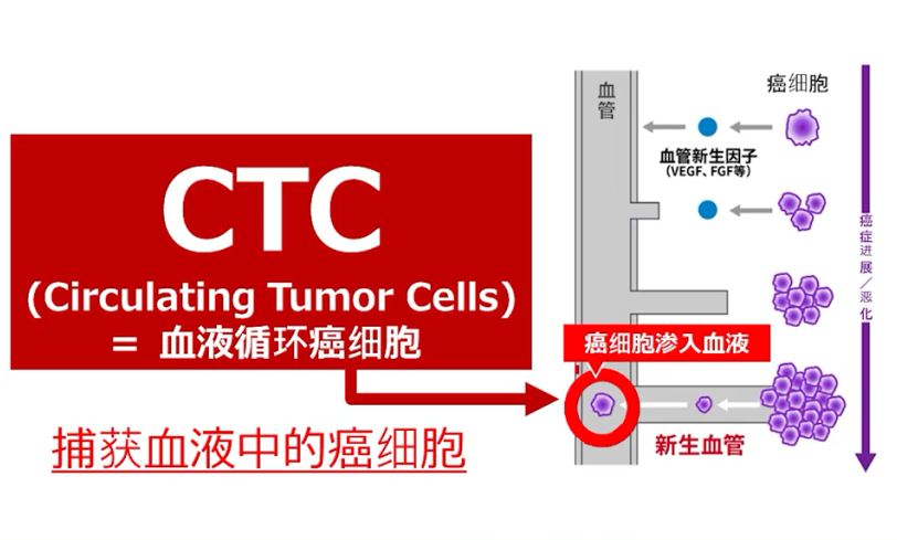 日本体检丨癌症早筛选择“微型CTC”，及时防范健康风险