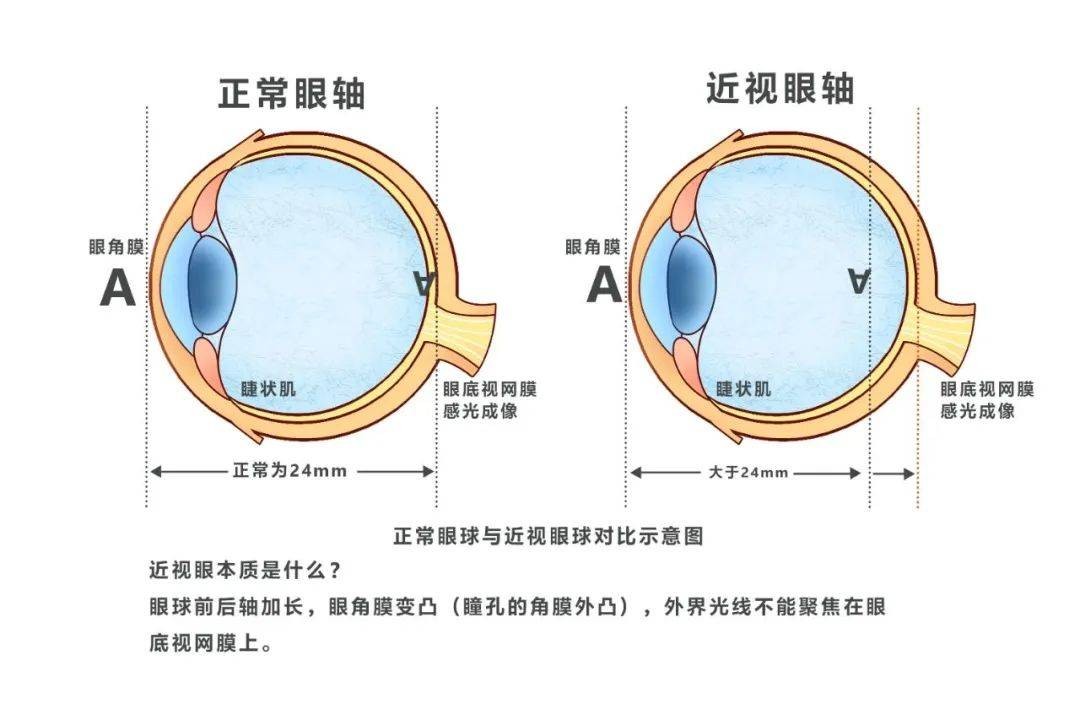 上海眼科院长：为什么高度近视更容易得白内障？能做手术治疗吗？