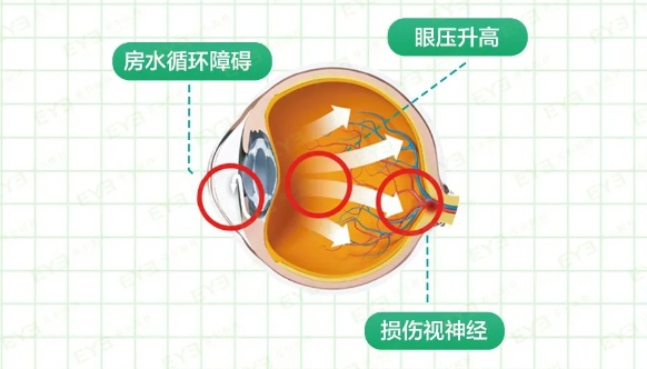 世界青光眼周来临，爱尔眼科提醒：早检早治，守护光明