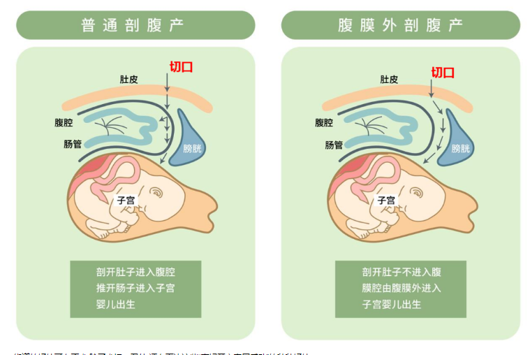 深圳永福医院圆满完成一例高难度腹膜外剖腹产手术，揭秘刀尖上的“产科艺术”！