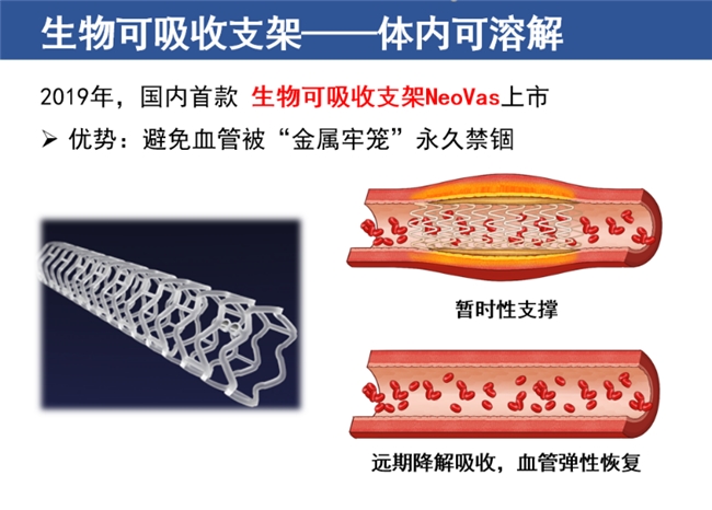 生物可吸收支架：告别“金属禁锢”，创新产品护佑冠心病患者健康